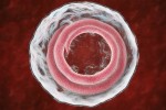 Trichinella Spiralis
